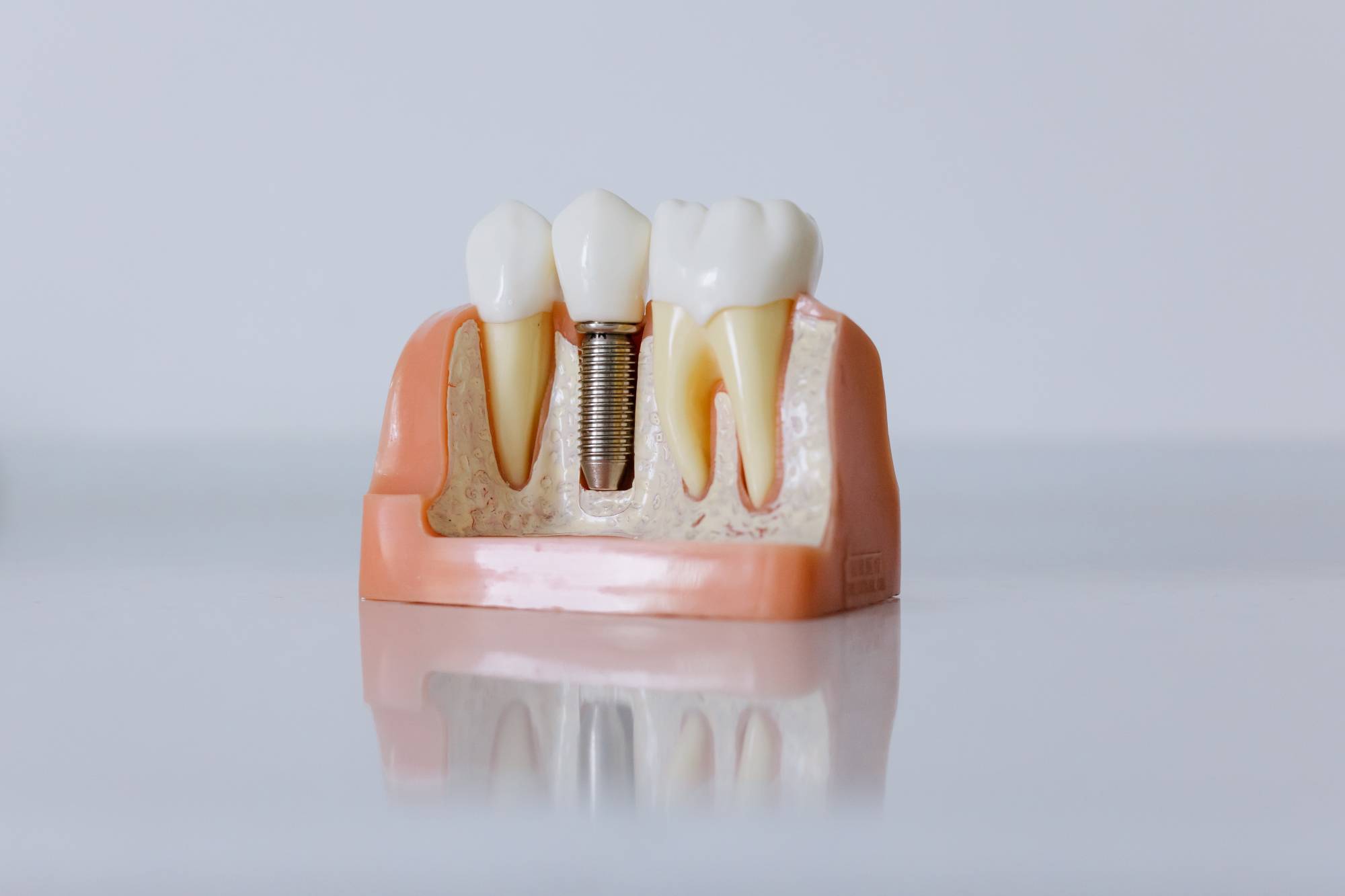 Dental Implant Image Dental Implant Image