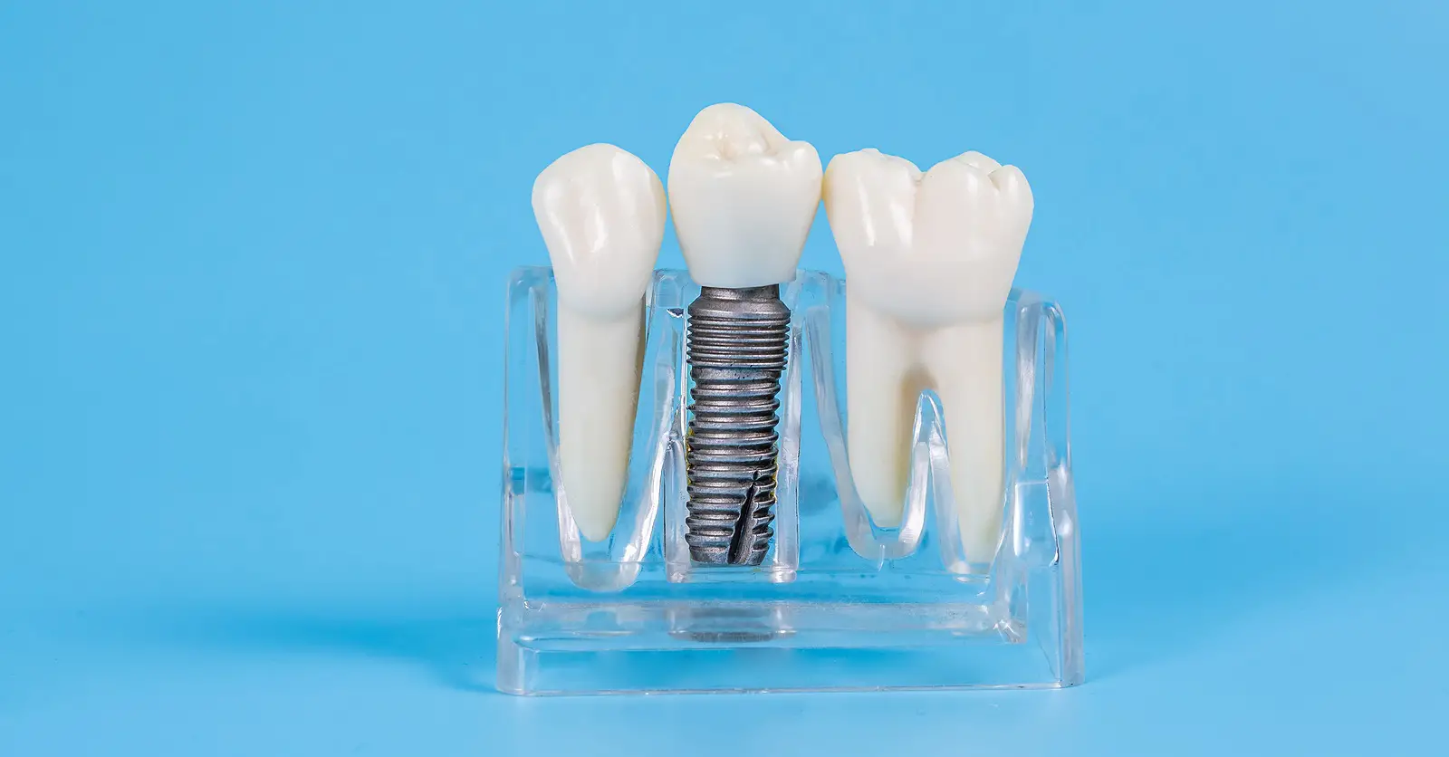 Dental Implants Dental Implants